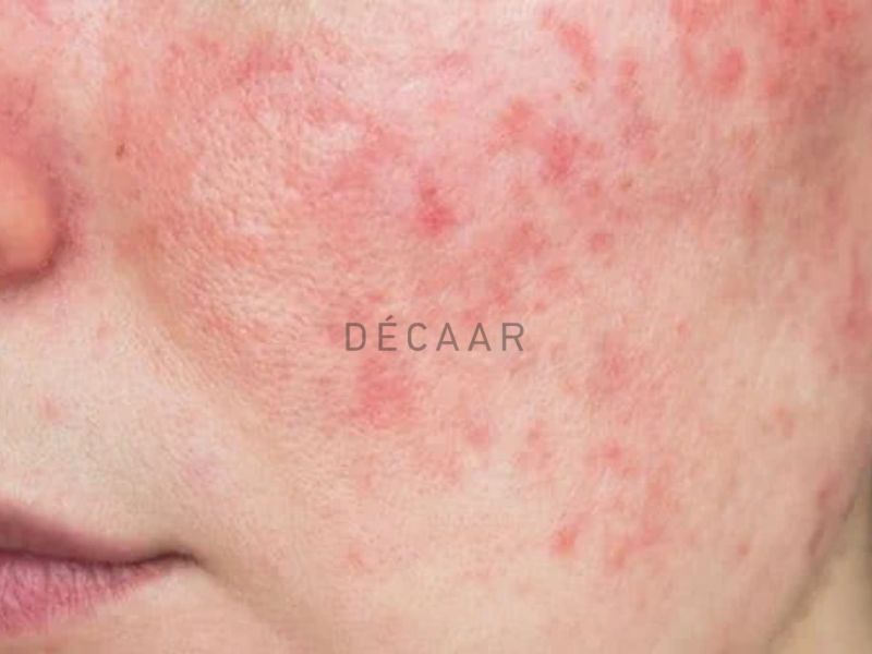 da bị nhiễm corticoid bao lâu thì khỏi